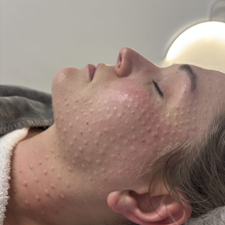 Mezoterapia igłowa - VS Akademia (1)